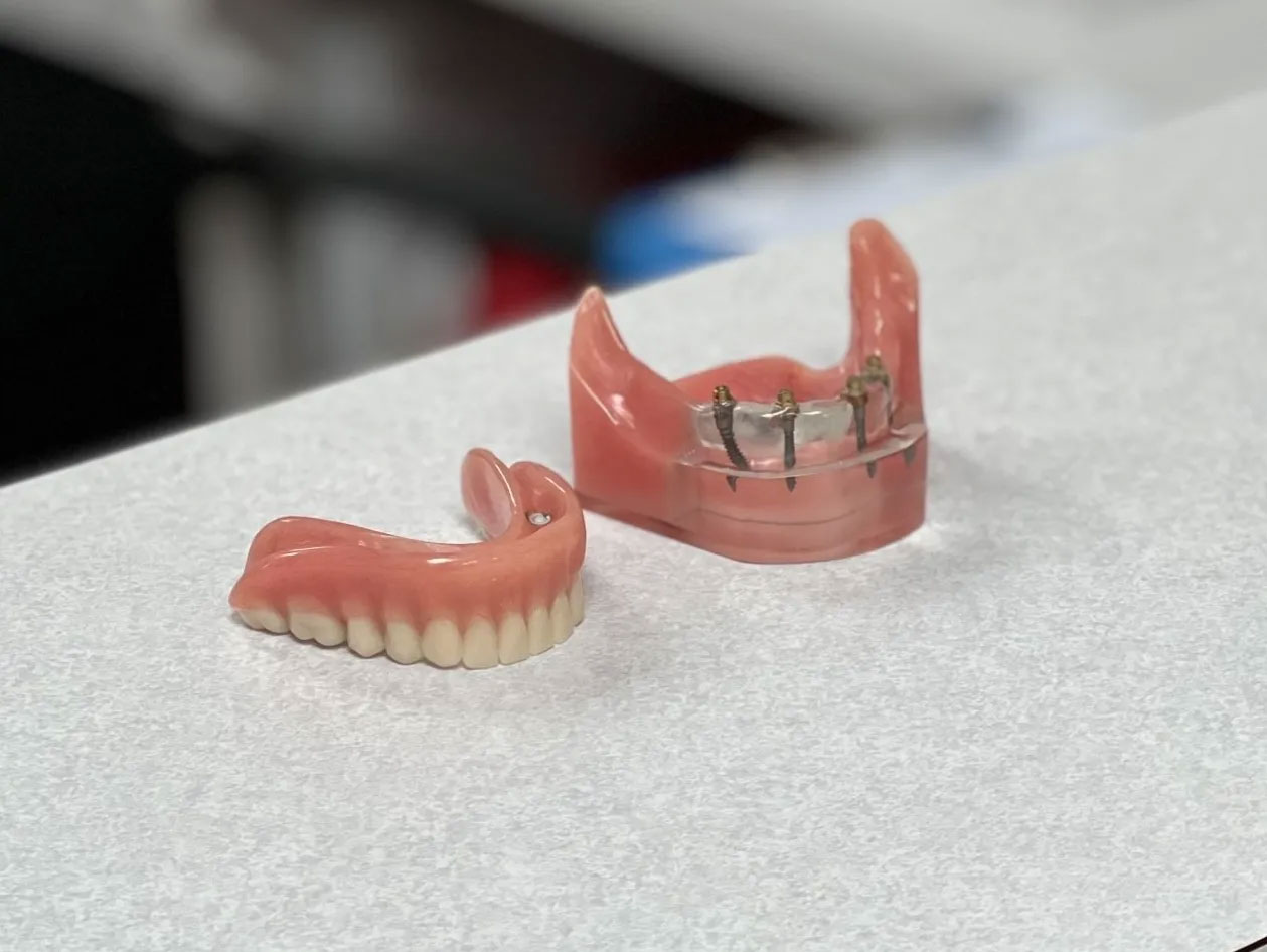 Dental Implants #1